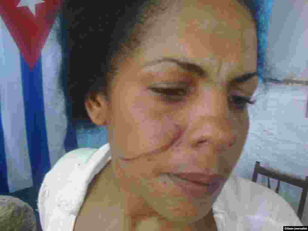  Yunaisi Carracedo, golpeada por la policía.